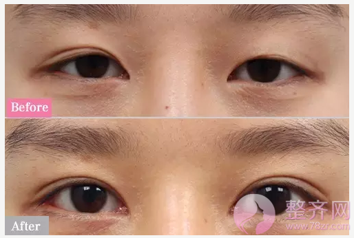 双眼皮手术后,医生为什么一定要让你去医院换