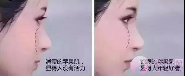 脂肪填充苹果肌 让你的颜值不停up up up!