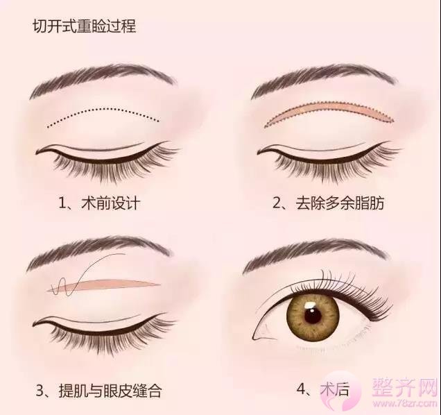 你还在纠结埋线法或切开法双眼皮哪种好?
