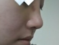 假体隆鼻后,劝我不要做的朋友都觉得很好看,