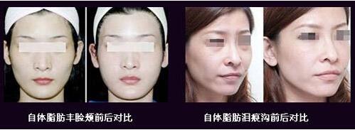 自体脂肪填充 做了自体脂肪填充多久可以洗脸?