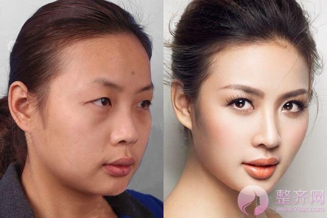 为什么脸已经很大,还要建议你做自体脂肪填充