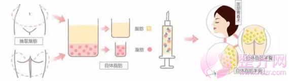 为什么脸已经很大,还要建议你做自体脂肪填充