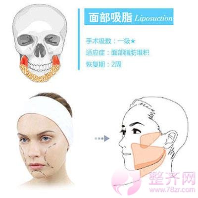 面部吸脂会有什么影响?