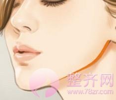 玻尿酸垫下巴你了解吗?