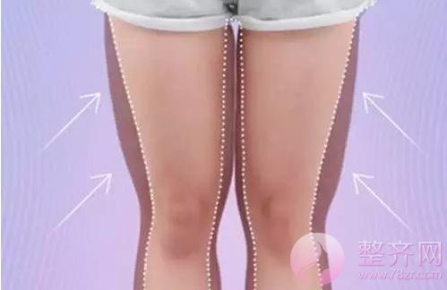 吸脂瘦大腿你该了解什么?
