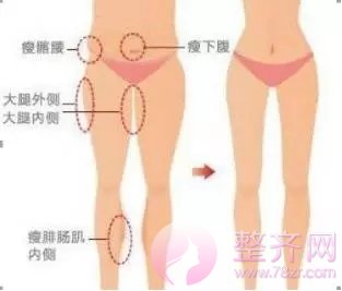 吸脂瘦大腿你该了解什么?