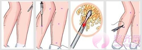 吸脂瘦大腿你该了解什么?