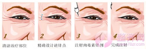 面部年轻化的3大绝招,你了解多少?