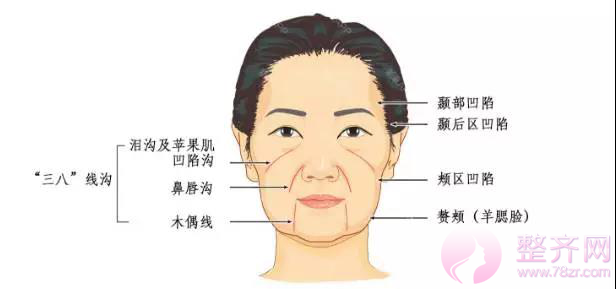 埋线提升提拉——提升、除皱、年轻化,抵抗地心引