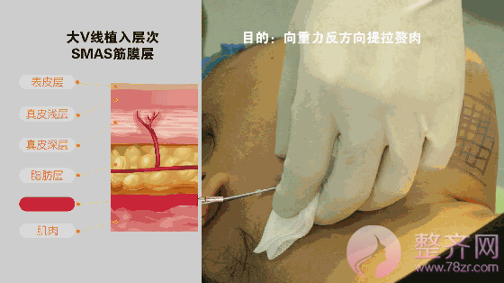 埋线提升提拉——提升、除皱、年轻化,抵抗地心引