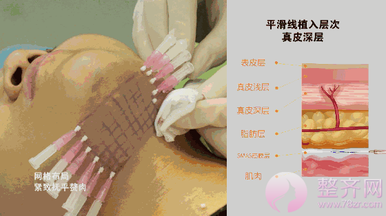 埋线提升提拉——提升、除皱、年轻化,抵抗地心引