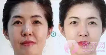 埋线提升提拉——提升、除皱、年轻化,抵抗地心引