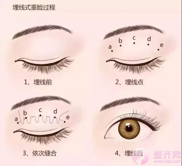 双眼皮贴老司机告诉我们,还是做长期的好,而