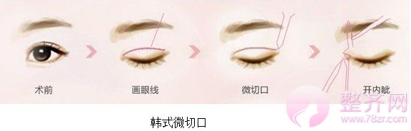 双眼皮贴老司机告诉我们,还是做长期的好,而