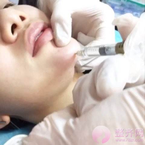 鼻子、下巴、额头一起做,侧脸无懈可击,正脸