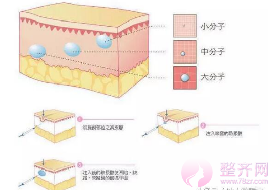 玻尿酸让你分分钟变美不是梦