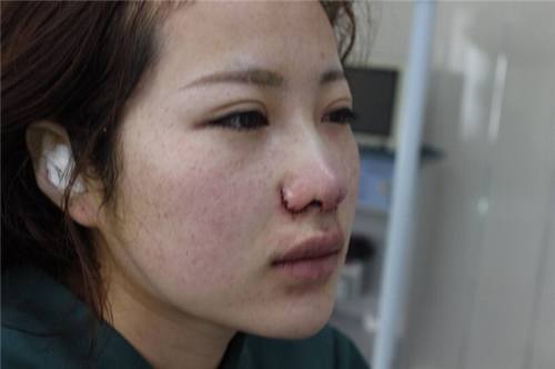 给姐妹们看看我的隆鼻案例,我的鼻子太漂亮,大家可不要羡慕我哦,哈哈哈哈,下面给大家看看我的变美经历!哇咔咔,嘿嘿~~~~