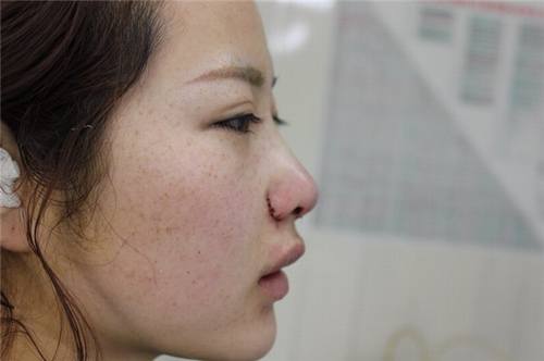 给姐妹们看看我的隆鼻案例,我的鼻子太漂亮,大家可不要羡慕我哦,哈哈哈哈,下面给大家看看我的变美经历!哇咔咔,嘿嘿~~~~
