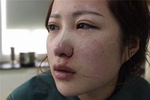 给姐妹们看看我的隆鼻案例,我的鼻子太漂亮,大家可不要羡慕我哦,哈哈哈哈,下面给大家看看我的变美经历!哇咔咔,嘿嘿~~~~