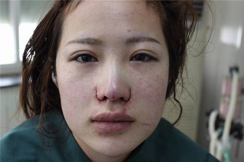 给姐妹们看看我的隆鼻案例,我的鼻子太漂亮,大家可不要羡慕我哦,哈哈哈哈,下面给大家看看我的变美经历!哇咔咔,嘿嘿~~~~