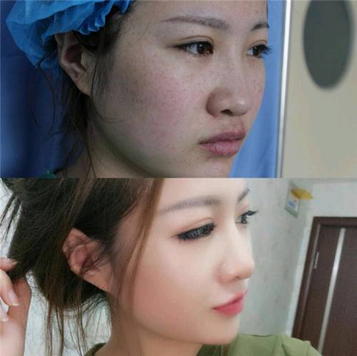 给姐妹们看看我的隆鼻案例,我的鼻子太漂亮,大家可不要羡慕我哦,哈哈哈哈,下面给大家看看我的变美经历!哇咔咔,嘿嘿~~~~