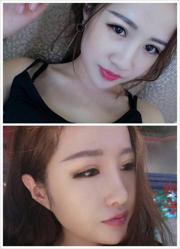给姐妹们看看我的隆鼻案例,我的鼻子太漂亮,大家可不要羡慕我哦,哈哈哈哈,下面给大家看看我的变美经历!哇咔咔,嘿嘿~~~~