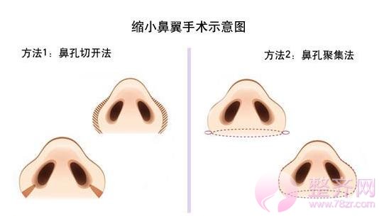打注射瘦脸就能缩小鼻头?