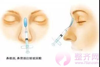 隆鼻就像婚姻,未必选较爱,却要较适合~