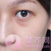 玻尿酸注射填充泪沟