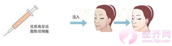除了玻尿酸,你的脂肪也是年轻化神器!