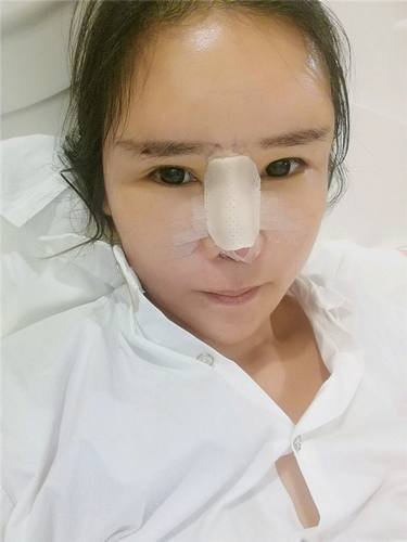 淘宝店主的变美经历,想要变美的看过来!! 隆鼻案例