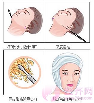 减肥不一定能让你告别肉肉脸,但面部吸脂一定