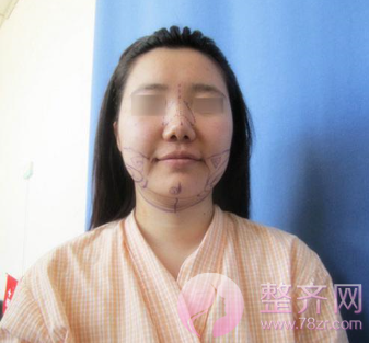 减肥不一定能让你告别肉肉脸,但面部吸脂一定