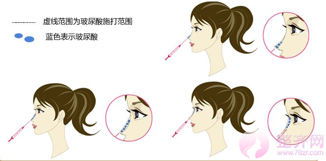 【用哪种手术方法可以改善塌鼻子呢】