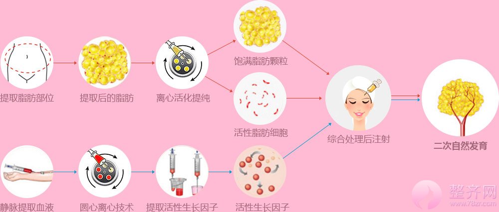 两项整形术 解决面部凹陷