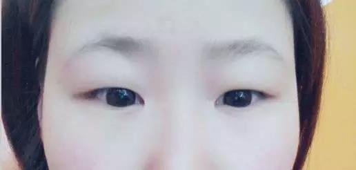 到底适合哪种双眼皮类型呢?