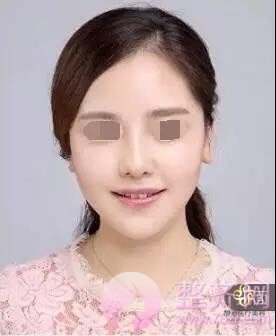 既然已经隆过鼻,为啥还要再做一次呢?