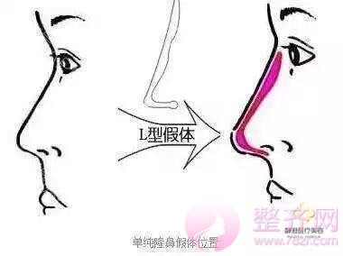 既然已经隆过鼻,为啥还要再做一次呢?