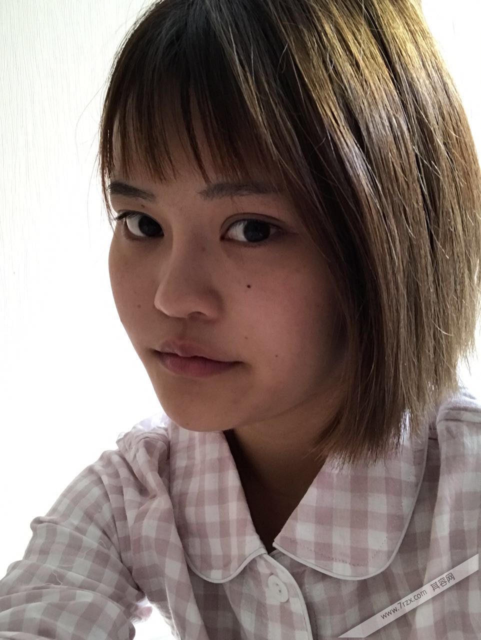 成都小姐姐的自体软骨隆鼻分享,打造欧美混血