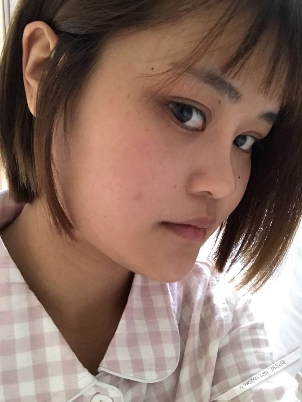 成都小姐姐的自体软骨隆鼻分享,打造欧美混血