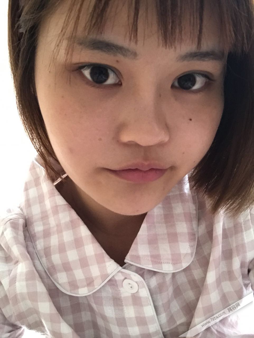 成都小姐姐的自体软骨隆鼻分享,打造欧美混血