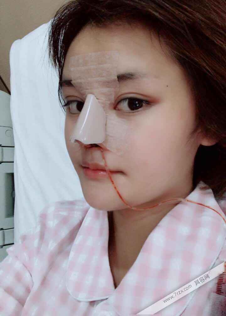 成都小姐姐的自体软骨隆鼻分享,打造欧美混血