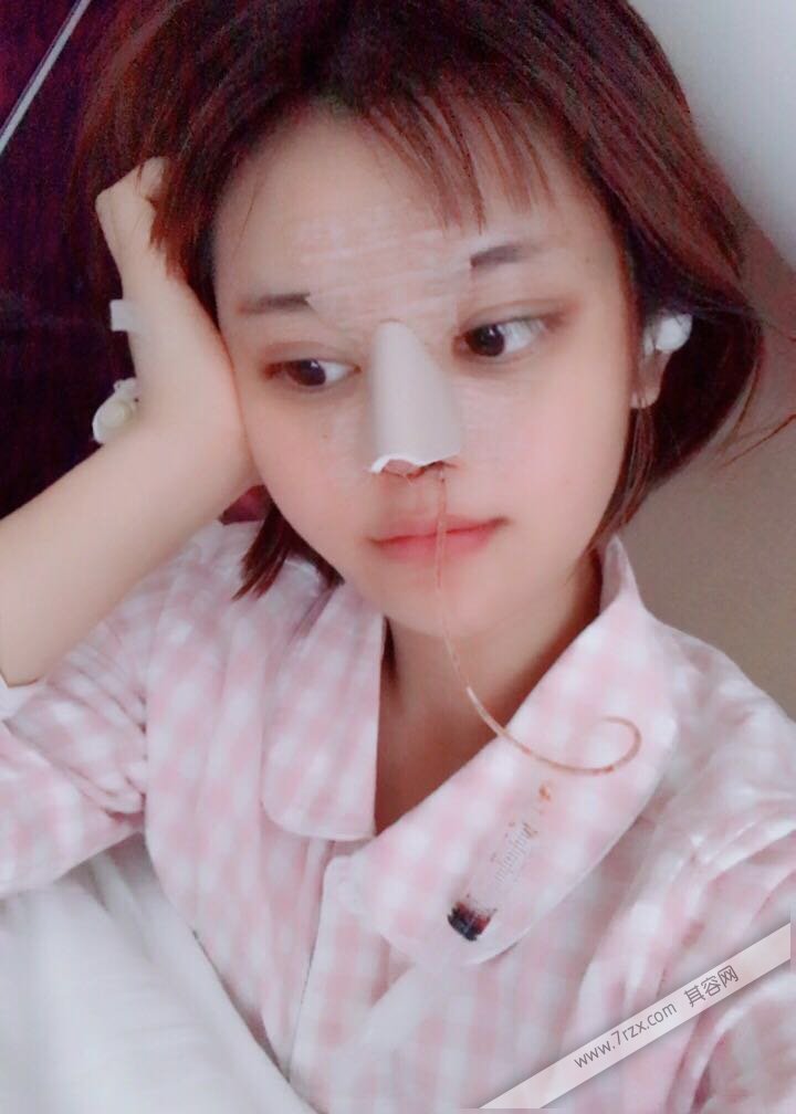 成都小姐姐的自体软骨隆鼻分享,打造欧美混血