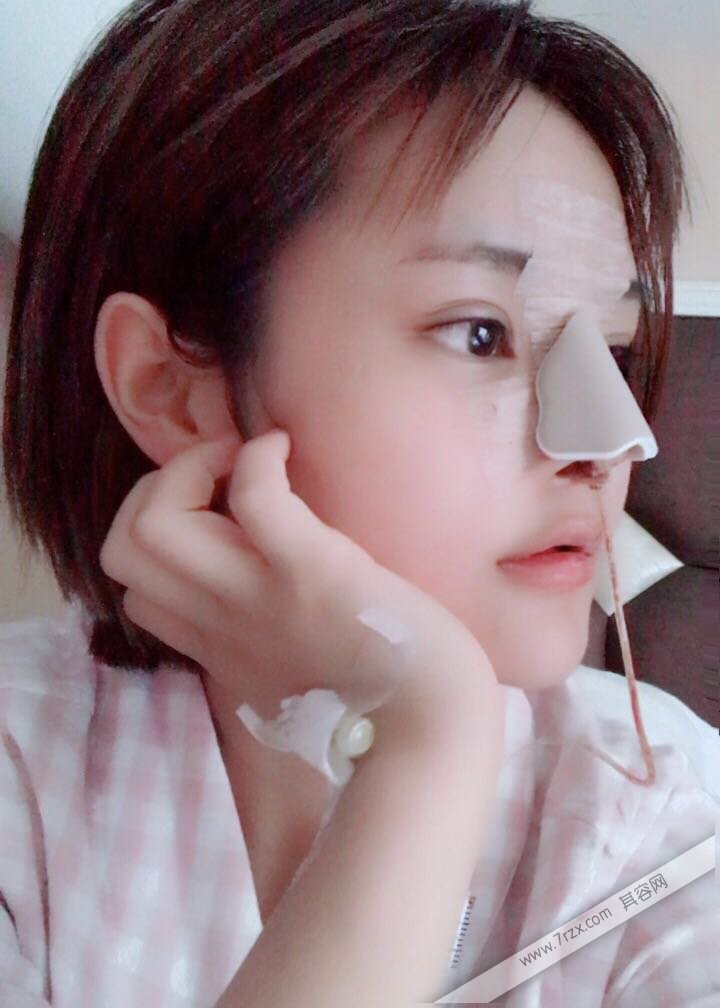 成都小姐姐的自体软骨隆鼻分享,打造欧美混血