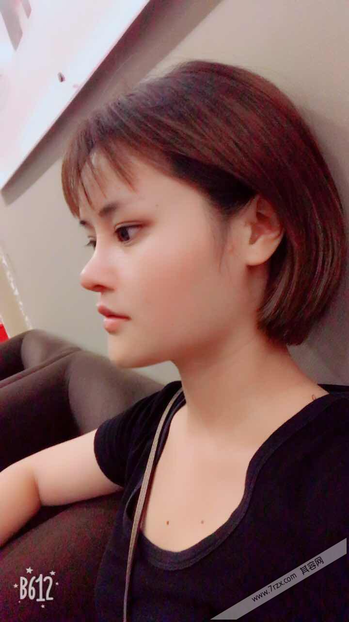 成都小姐姐的自体软骨隆鼻分享,打造欧美混血