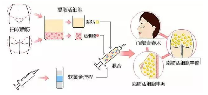 自体脂肪是如何让你变美的?