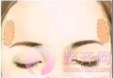 自体脂肪面部填充后,真的能年轻了10岁?
