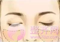 自体脂肪面部填充后,真的能年轻了10岁?