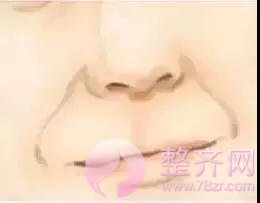 自体脂肪面部填充后,真的能年轻了10岁?